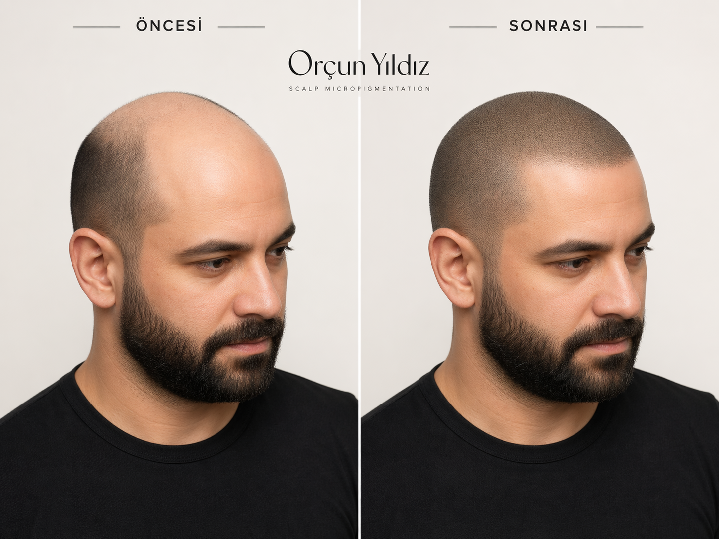Tepe bölgesi yoğunluk etkisi Tepe bölgesi saç simülasyonu öncesi sonrası yoğunluk etkisi örneği