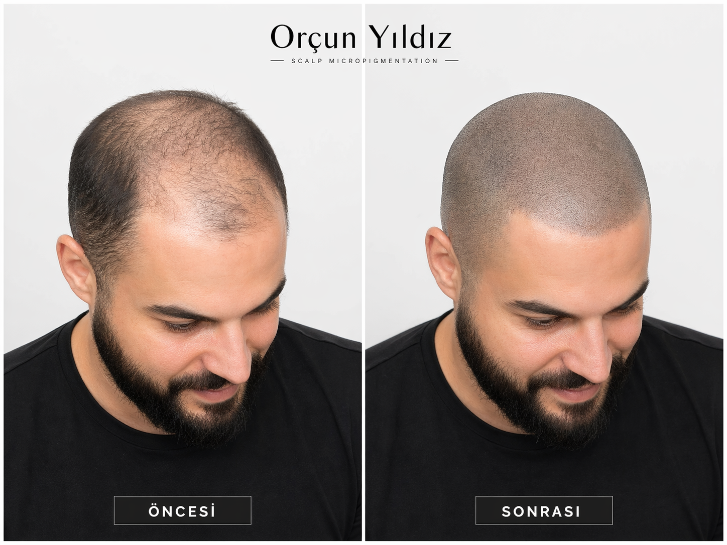 Kadın saç seyrekliği çözümü Kadın saç seyrekliği çözümü öncesi sonrası doğal saç simülasyonu örneği