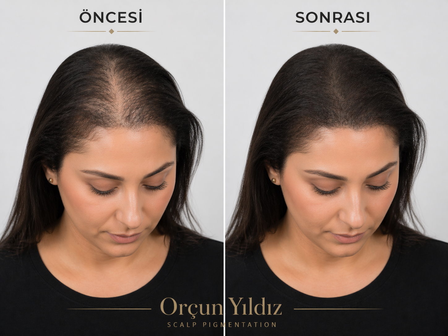 Kadın öncesi sonrası saç simülasyonu Kadın öncesi sonrası saç simülasyonu ile doğal yoğunluk görünümü örneği