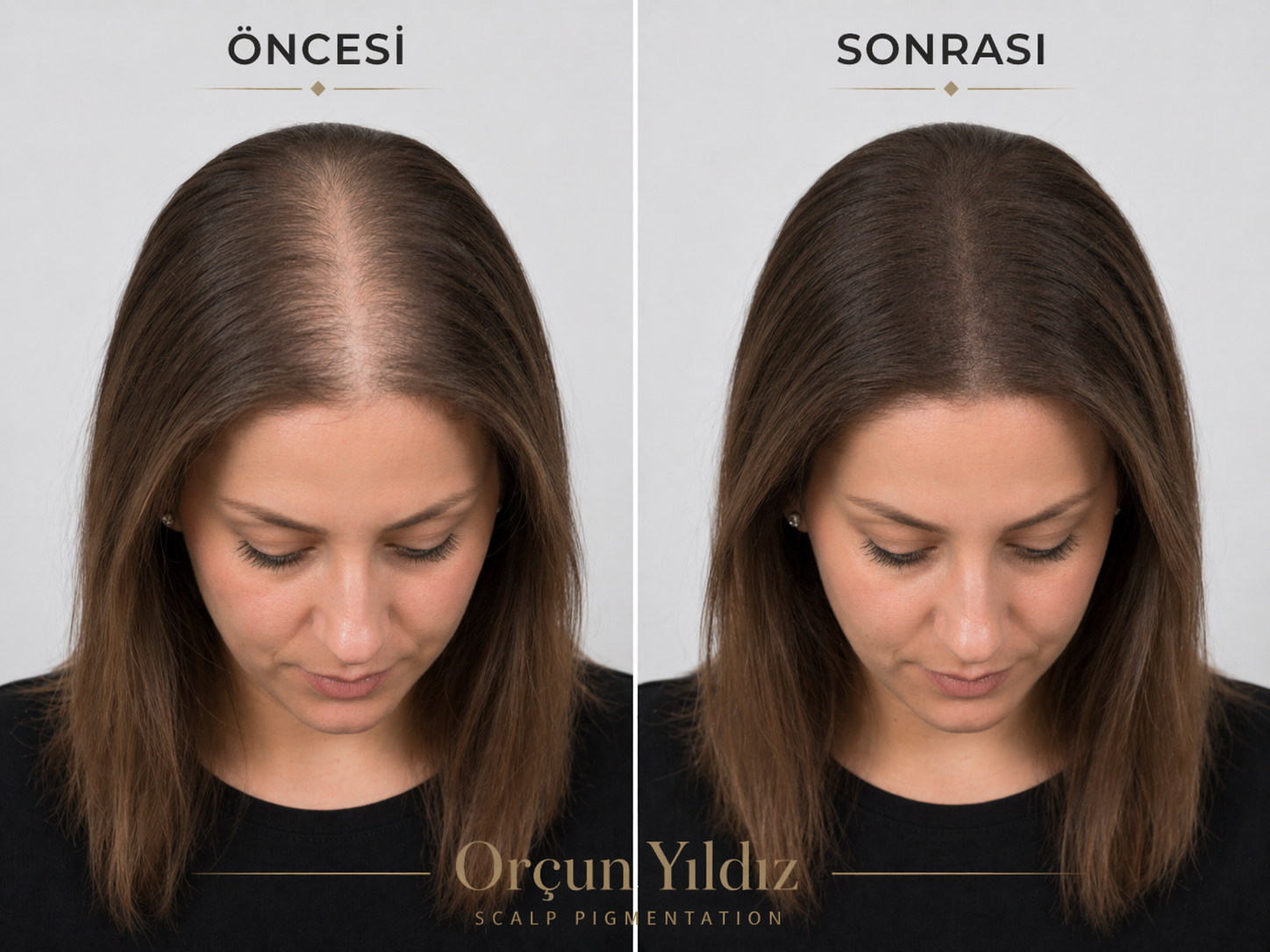 Kadın saç yoğunluğu örneği Saç simülasyonu merkezi kadın saç yoğunluğu öncesi sonrası örneği
