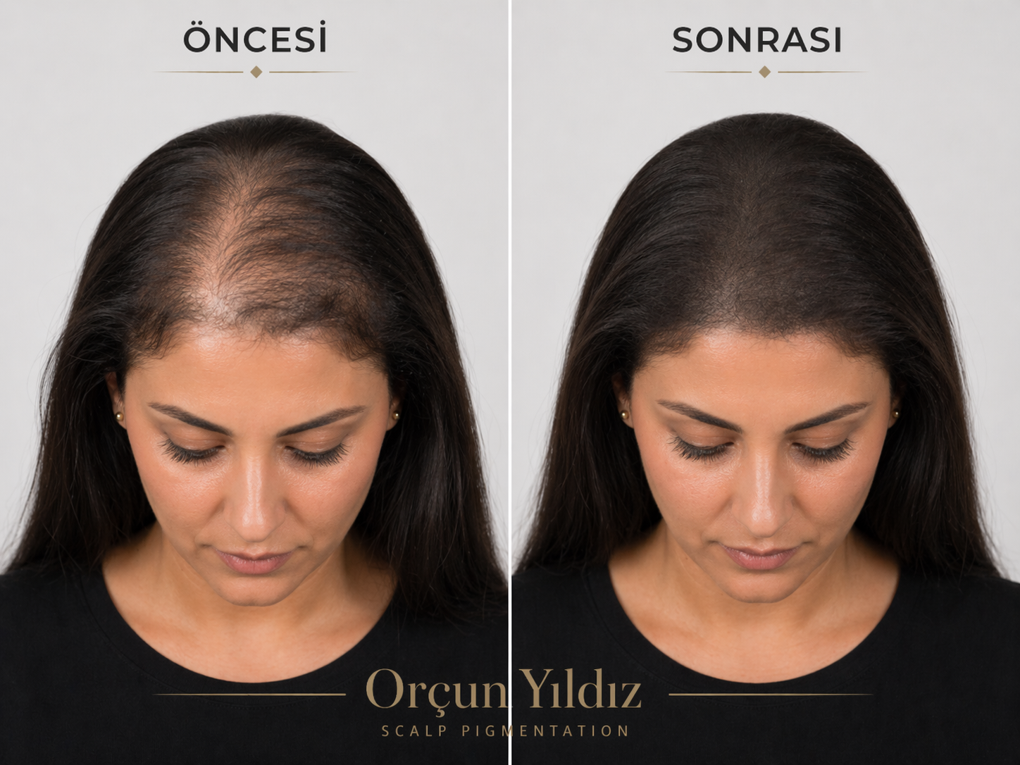 Kadın saç seyrekliği çözüm örneği Kadın kafa derisi mikropigmentasyonu ile saç seyrekliği çözümü örneği