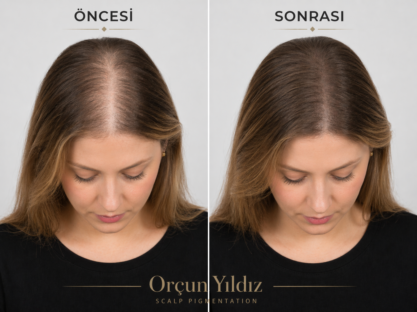 Kadın üst bölge kapatıcılık örneği Kadın doğal saç simülasyonu öncesi sonrası üst bölge kapatıcılık örneği