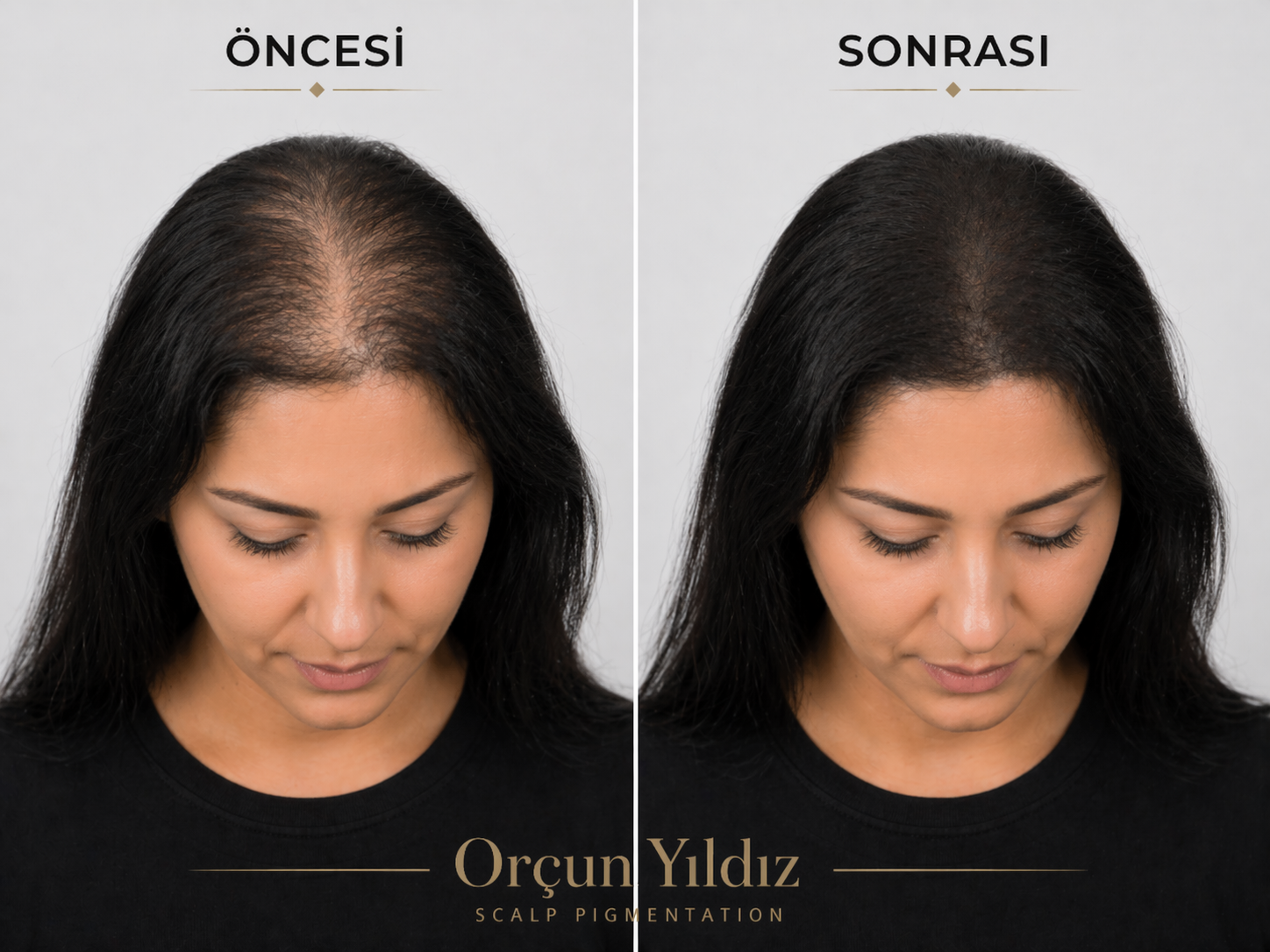 Kadın saç çizgisi ve yoğunluk örneği Kadın saç çizgisi ve saç yoğunluğu öncesi sonrası doğal görünüm örneği