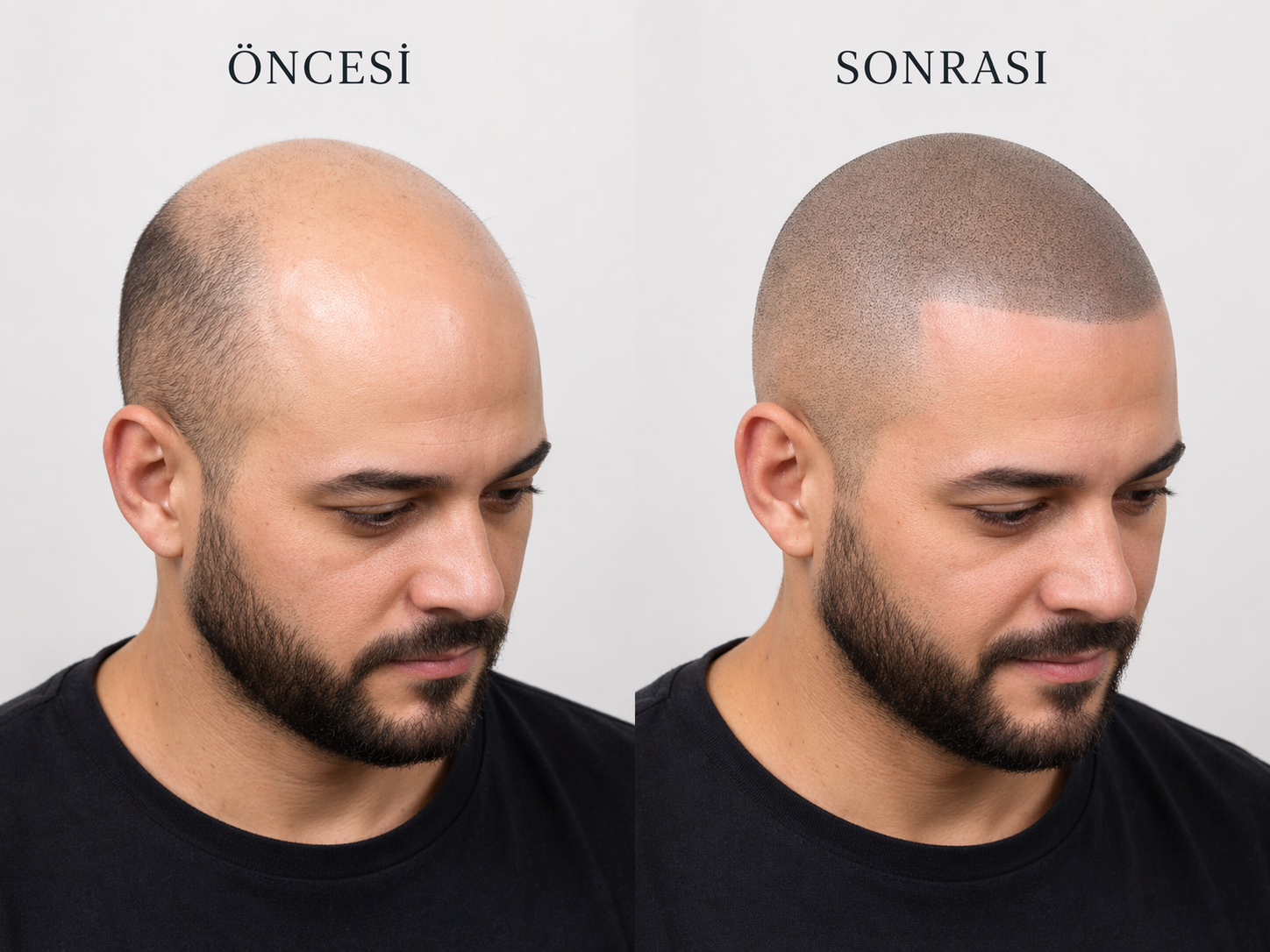 Kellik görünümü kapatma örneği Öncesi sonrası saç simülasyonu ile kellik görünümü kapatma örneği