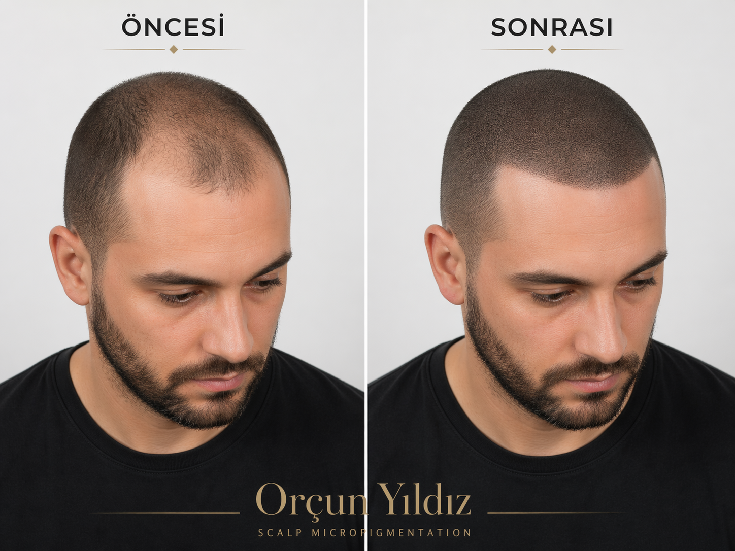 Alın çizgisi saç simülasyonu örneği Adana saç simülasyonu öncesi sonrası alın çizgisi saç simülasyonu örneği