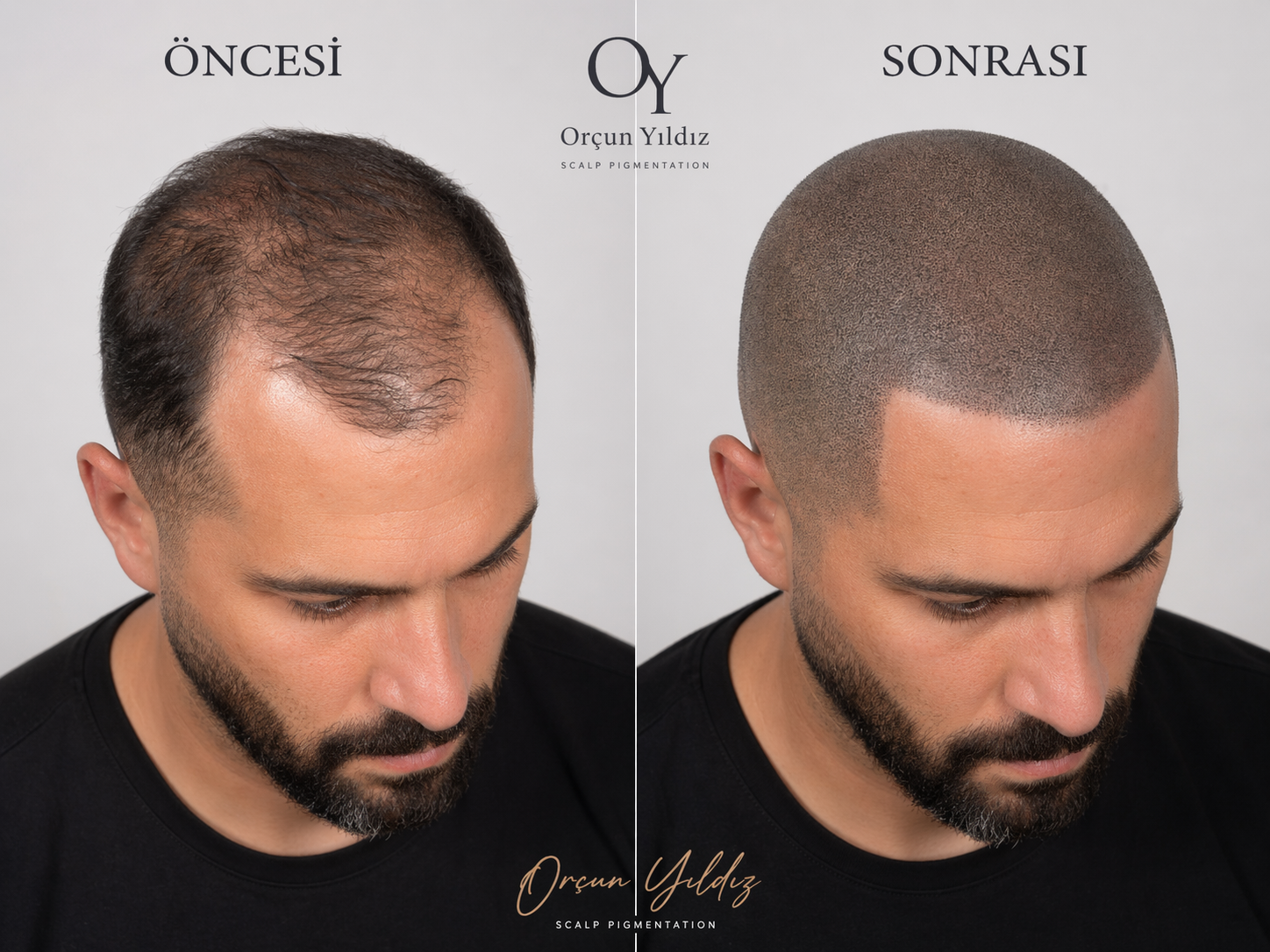 Saç seyrekliği çözümü örneği Saç seyrekliği çözümü için öncesi sonrası saç simülasyonu örneği