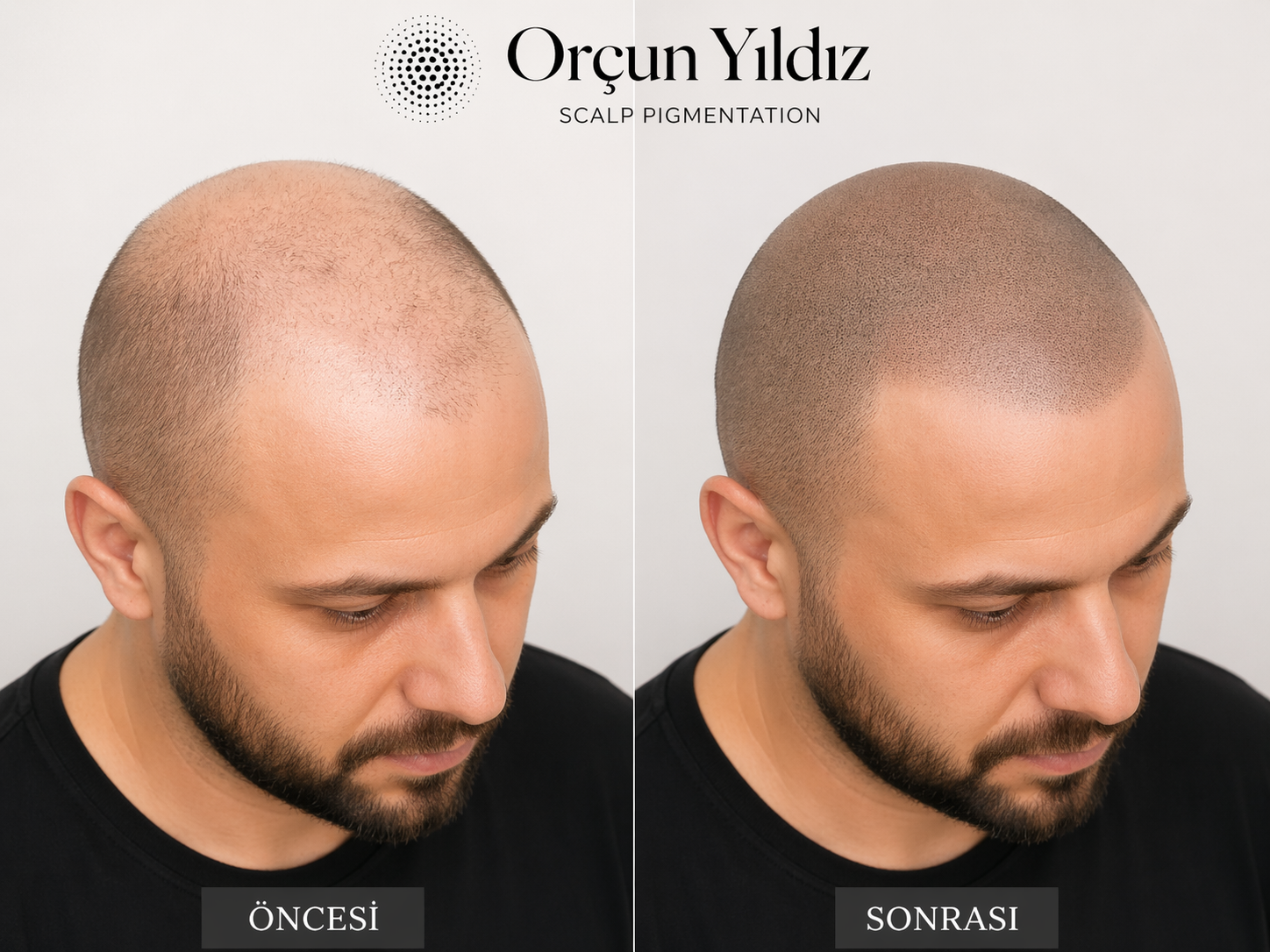 Kafa derisi mikropigmentasyonu örneği Kafa derisi mikropigmentasyonu ve saç gölgelendirme öncesi sonrası örneği